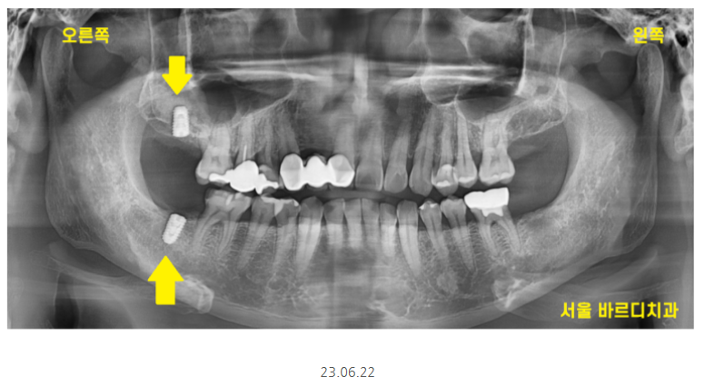 명일동 치과 임플란트 위아래 같이 할 수 있나요?? 관련 이미지 4