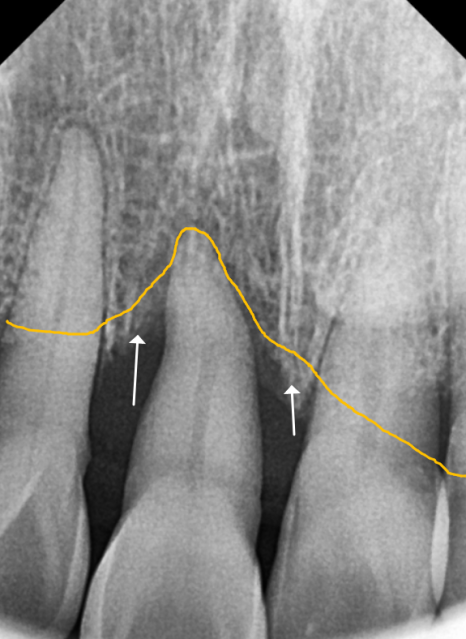 고덕동 스케일링 미루다 앞니 어금니 다 뽑고 임플란트 했습니다. 관련 이미지 4