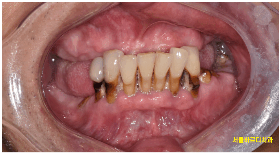 고덕역  치과 틀니쓰다 위아래 전악 임플란트 재건했습니다. 관련 이미지 1