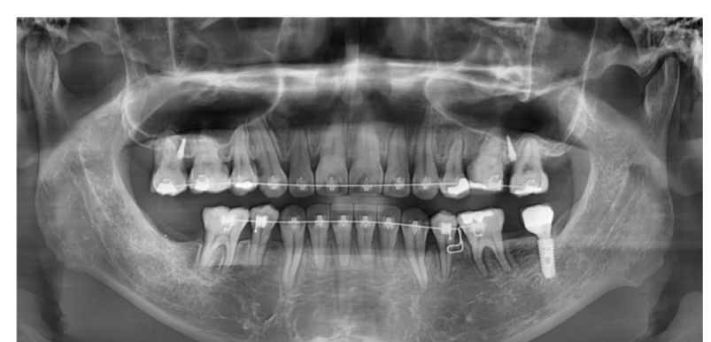 고덕동 치아교정 치아 이동 속도가 느려요 원인은? 관련 이미지 6