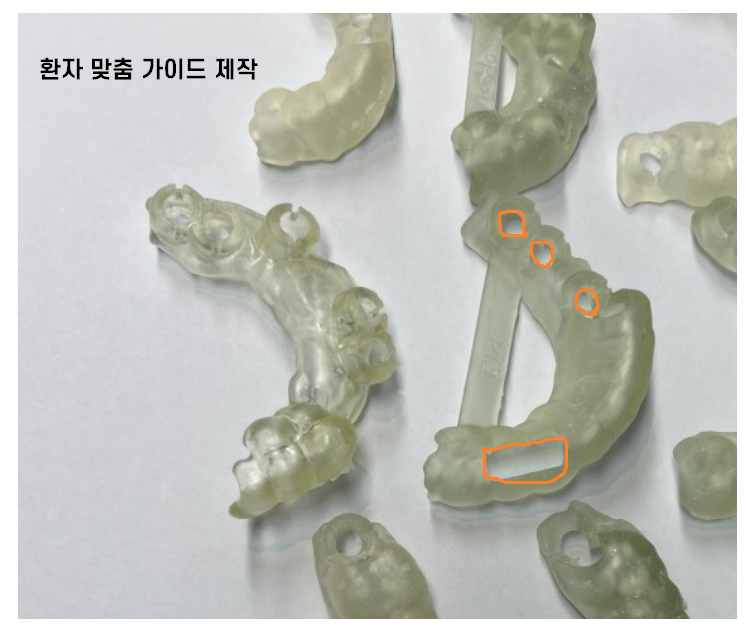 암사동 치과 전악 임플란트 하루만에 끝냈습니다. 관련 이미지 8