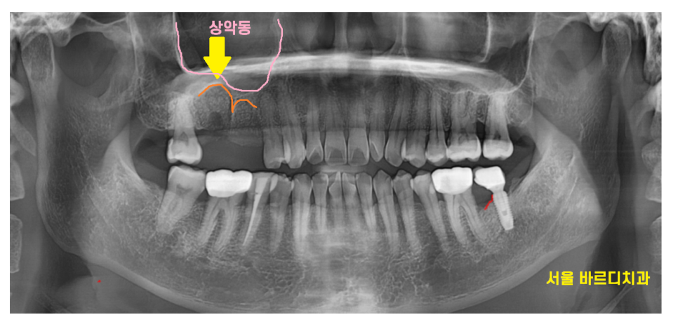 고덕역 임플란트 잇몸 뾰루지 뼈이식 두번 하여 해결했습니다. 관련 이미지 6