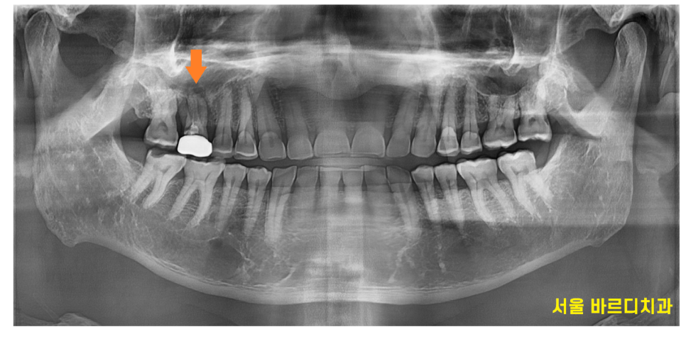 망월동 치과 염증이 심하면 임플란트 바로 못심어요 잇몸뼈 함몰 케이스 관련 이미지 2