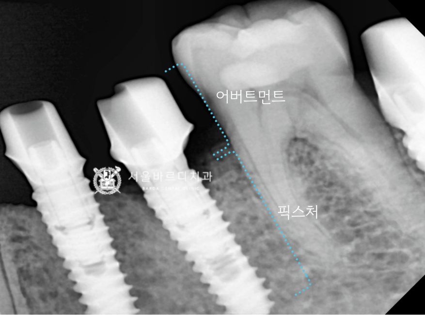 고덕동치과 서울바르디치과 무절개 네비게이션 임플란트 치료증례 #1 관련 이미지 14