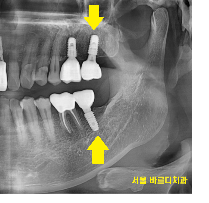 강동구 임플란트 위 아래 어금니 동시 식립으로 치료기간 대폭 축소 관련 이미지 7