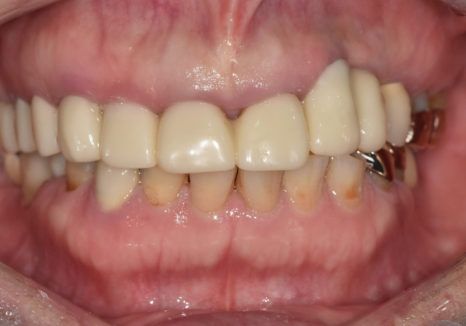 앞니 브릿지 탈락, 씌워둔 게 빠졌어요. 다시 붙일 수 있을까요? 관련 이미지 6