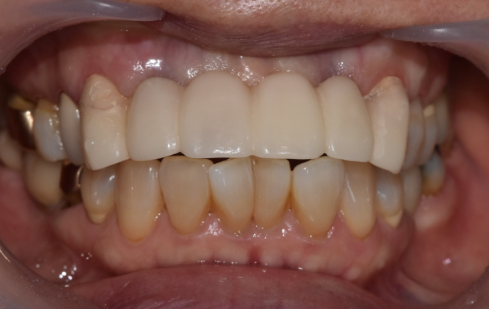 명일동 앞니 브릿지, 새로 교체 할 때 꼭 확인해 봐야 할 관련 이미지 8