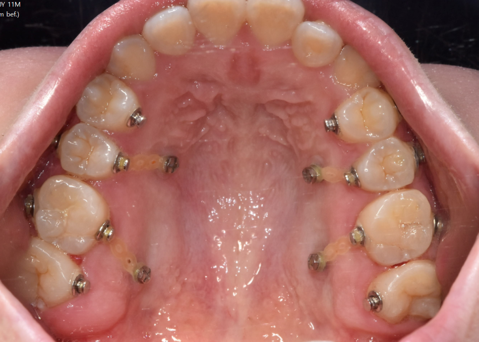 상일동 치아 교정 고려해봐야할 2가지 요소 관련 이미지 5