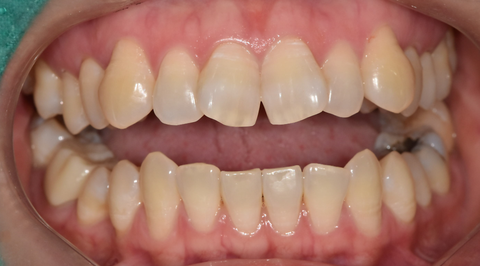 나비 모양 앞니 2가지 방법으로 개선 가능합니다. 관련 이미지 4