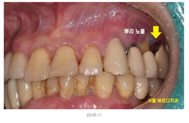미사 임플란트 70대 연령과 상관없는 치료 과정 관련 이미지 4