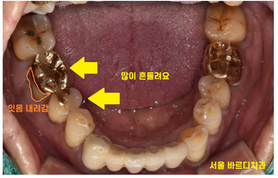 하남시청치과 치아 욱신거림 임플란트로 치료해드렸습니다. 관련 이미지 5
