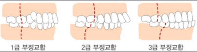 고덕동 교정치과 부정교합은 무엇인가요? 어떨때 치료가 필요한가요? 관련 이미지 8