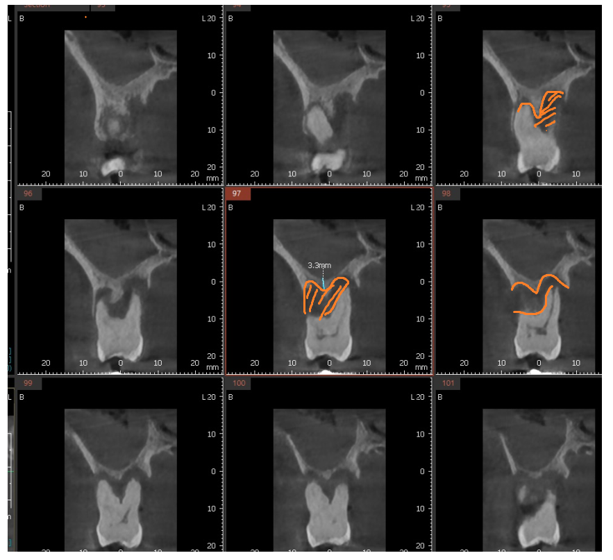 잇몸 고름 냄새 약으로 없앨 수는 없나요? 무시 무시한 치주염 관련 이미지 5