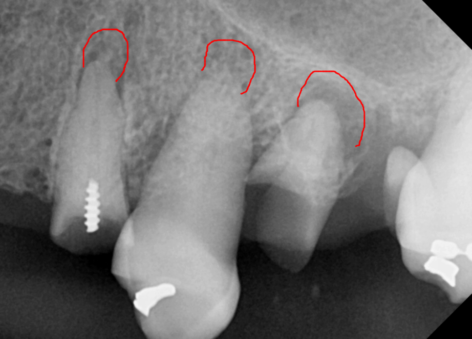 뿌리만 남은 치아, 그대로 두면 왜 위험할까요? 고덕동 전체 임플란트 재건 사례 관련 이미지 6