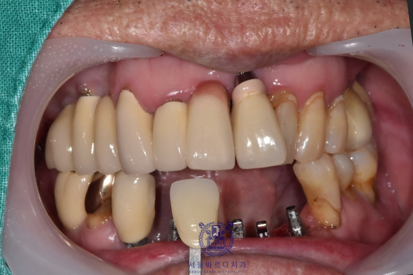 고덕동치과 서울바르디치과 전치부 및 구치부 임플란트 치료증례 #10 관련 이미지 14
