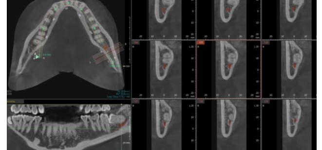 강동구 사랑니 묻혀있는 매복치아 꼼짝마!!! 뽑아줄테니까 관련 이미지 6