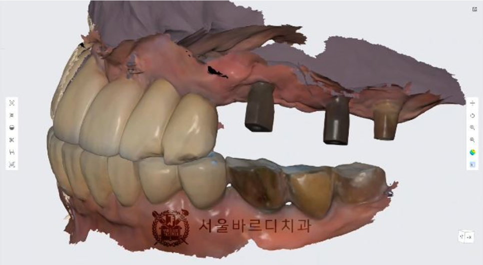 상일동역치과 서울바르디치과 무절개 네비게이션 임플란트 치료증례 #5 관련 이미지 14