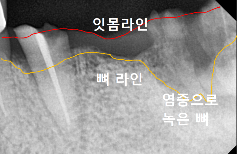 오래된 어금니 롱브릿지, 교체 타이밍을 놓치면 관련 이미지 13