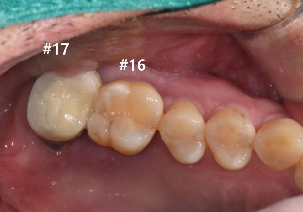 상악동 거상술 부작용 걱정되시나요? 재수술 없는 뼈이식의 정석 공개 관련 이미지 3