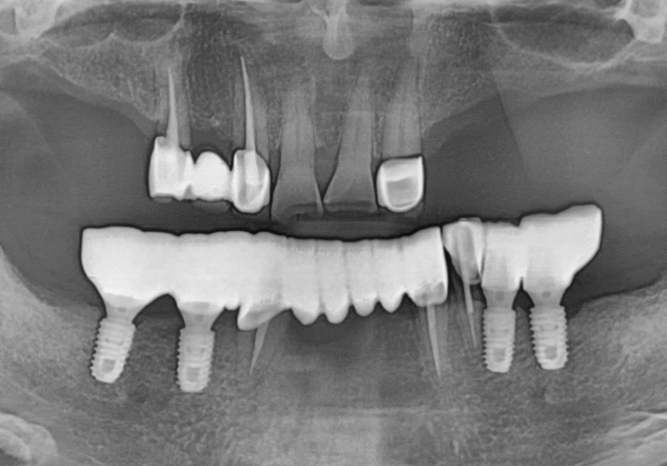 Godeok-dong Tooth Fracture: Check This Before Getting an Implant! Revealing the Criteria for Saving It image 16