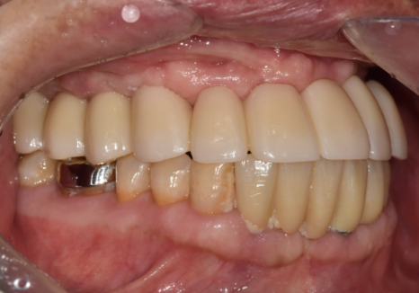 뼈가 없어서 안 된다구요? 70대 당뇨 무치악 환자분의 전체 임플란트 사례 관련 이미지 18