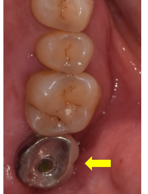 고덕동치과 임플란트 악취 냄새가 나는 이유는? 관련 이미지 5