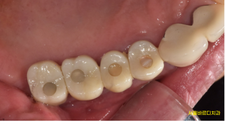 예전에 씌운 이 상악동 거상술 뼈이식 동반하여 임플란트 완료 관련 이미지 9