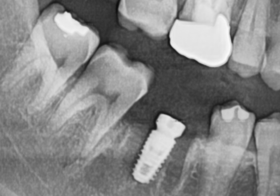 고덕동 어금니 사이 충치, 양치질 누구보다 열심히 하는데 왜 자꾸 생길까요? 관련 이미지 13