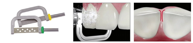 치아 교정 중 치간 삭제 치아를 깎는다고요??? 관련 이미지 7