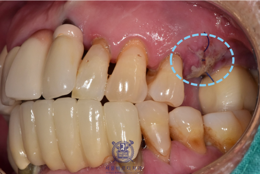 고덕동치과 서울바르디치과 전치부 및 구치부 임플란트 치료증례 #10 관련 이미지 4