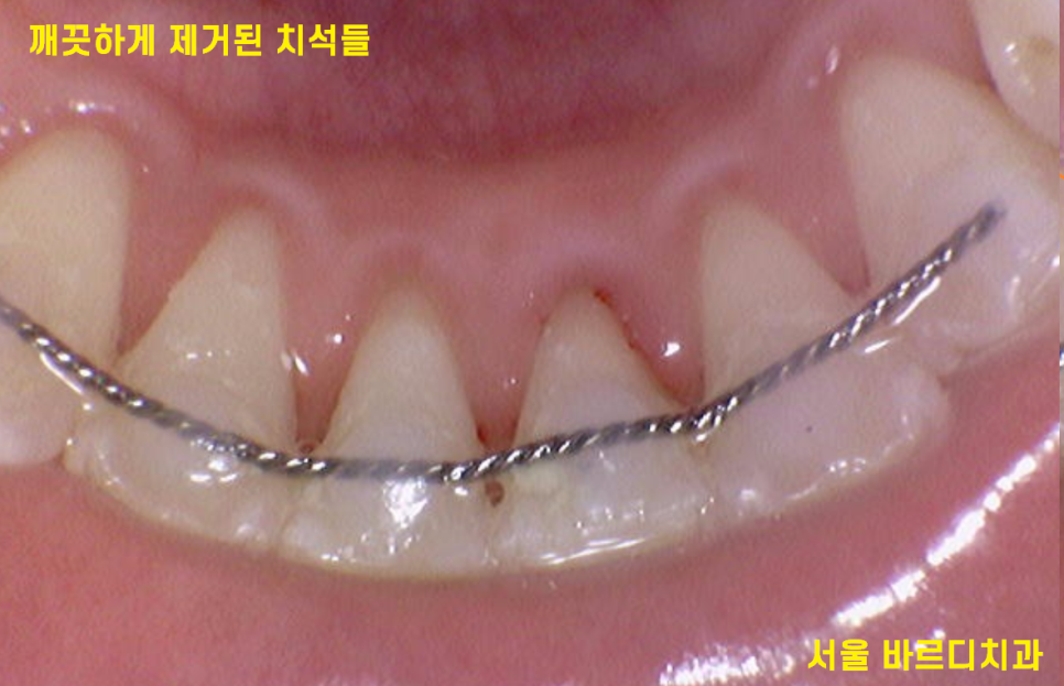 치과 유지장치 떨어짐 언제까지 하고 있어야하나요? 관련 이미지 4