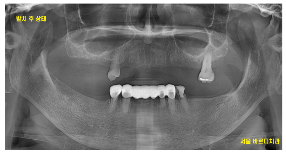 강동구 임플란트 어금니 상실 방치하다 치매까지 옵니다. 관련 이미지 7