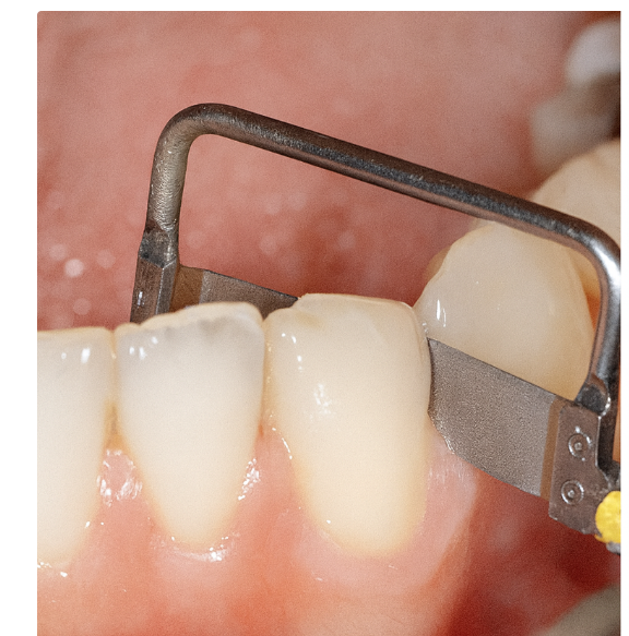 Are There Any Side Effects of Interproximal Reduction During Orthodontic Treatment? Click Here If You’re Concerned image 3