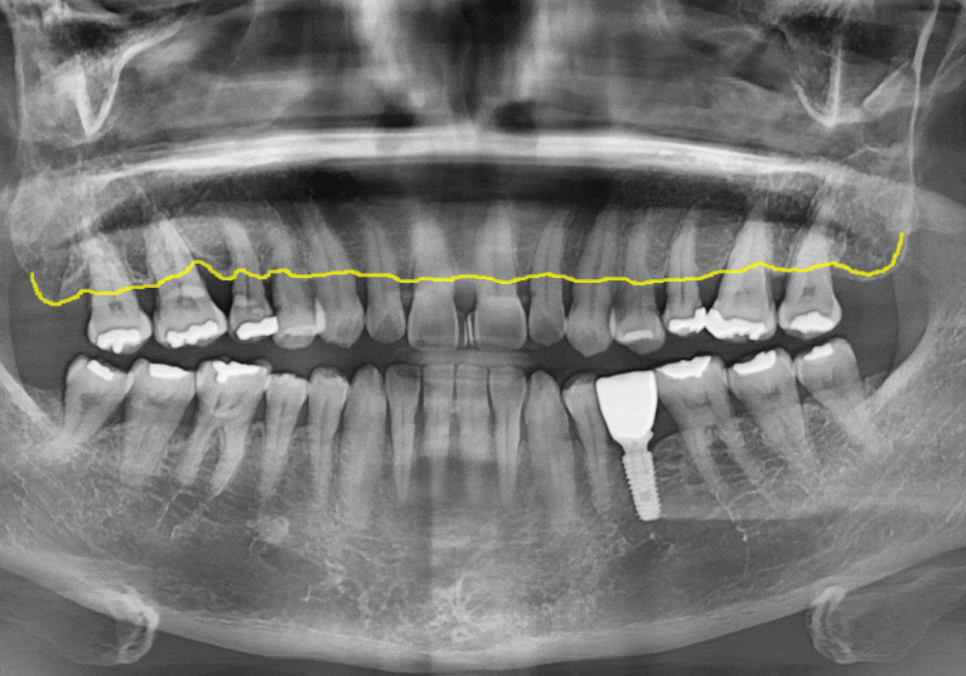 고덕동 치과 누런 이, 앞니 사이 틈, 잘못된 관리 때문일까? 관련 이미지 4