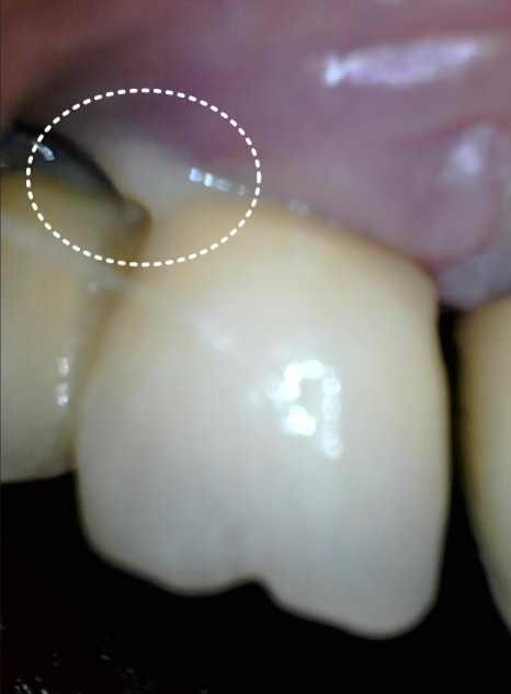 오래된 임플란트, 흔들림과 통증, 어떻게 하면 더 건강하게 쓸 수 있을까? 관련 이미지 1