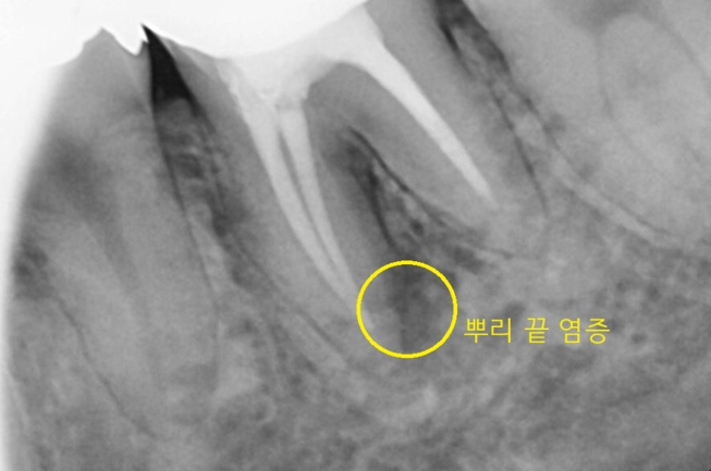 감일동 치과 첫번째 임플란트 시작이 중요합니다. 관련 이미지 5