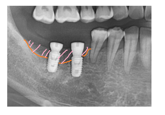 고덕동 임플란트 골이식 필수일까? 궁금증 여기 모두 있어요 관련 이미지 7