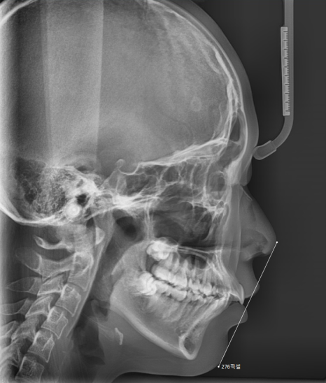 강동구 교정치과 교정 진단비와 관련된 공지 관련 이미지 4
