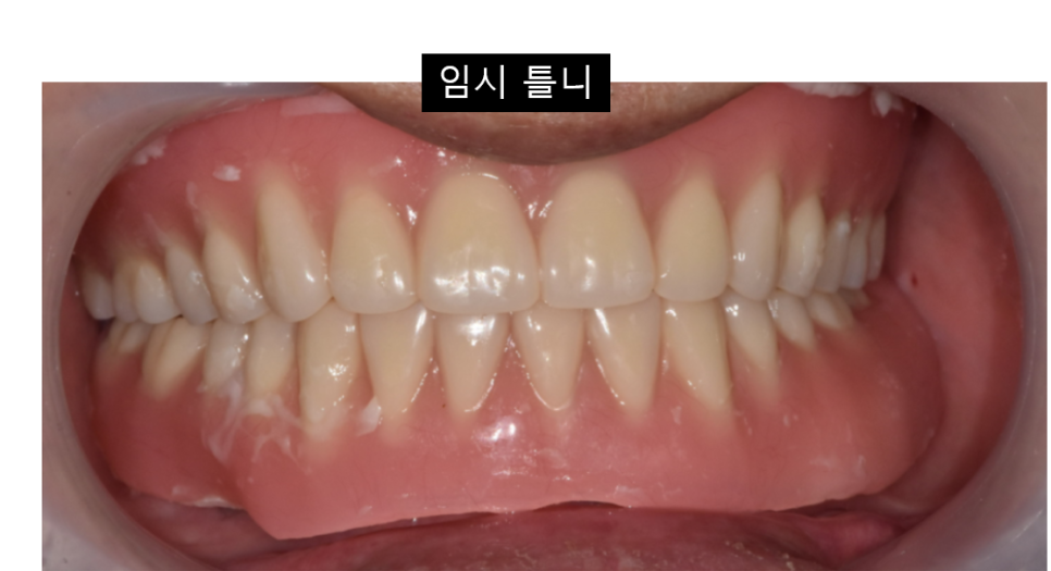 임플란트 양쪽 동시에 해도 될까? 우려되시는 분들 클릭 관련 이미지 6