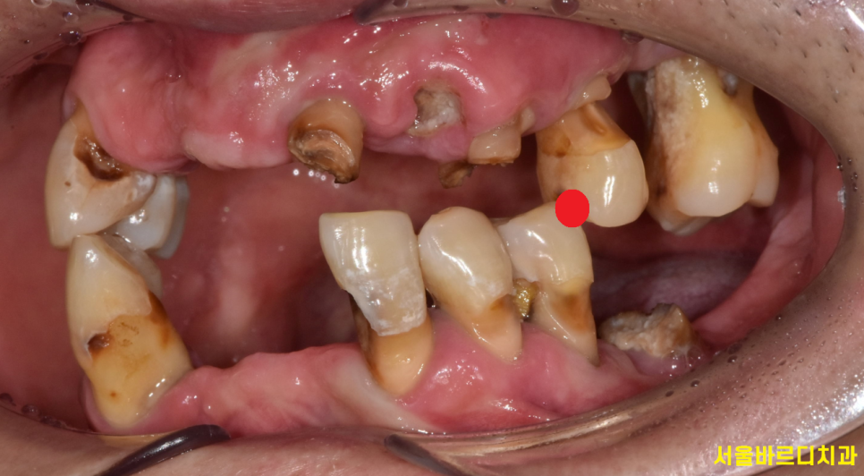 앞니 어금니 임플란트 동시에 진행할때 순서는? 관련 이미지 3