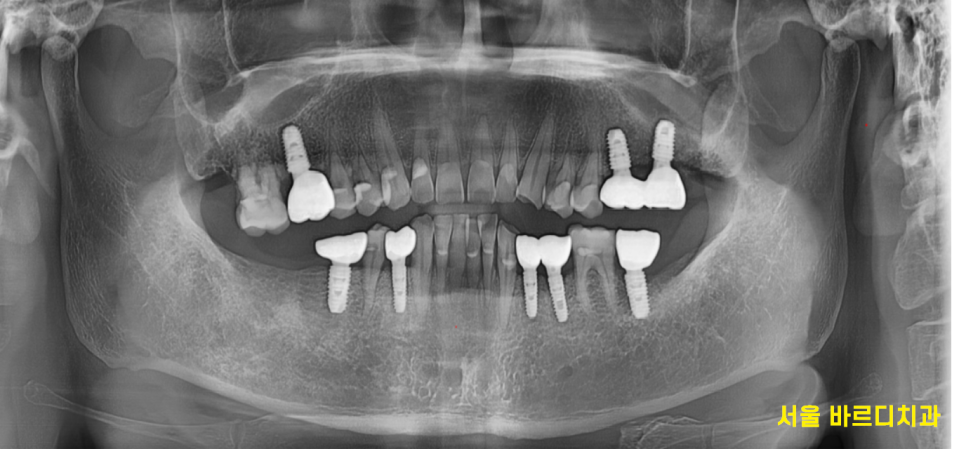 망월동 치과 어금니 빠짐 임플란트 대안이 될 수 있습니다. 관련 이미지 10