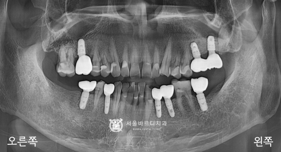 고덕동치과 서울바르디치과 무절개 네비게이션 임플란트 치료증례 #1 관련 이미지 19
