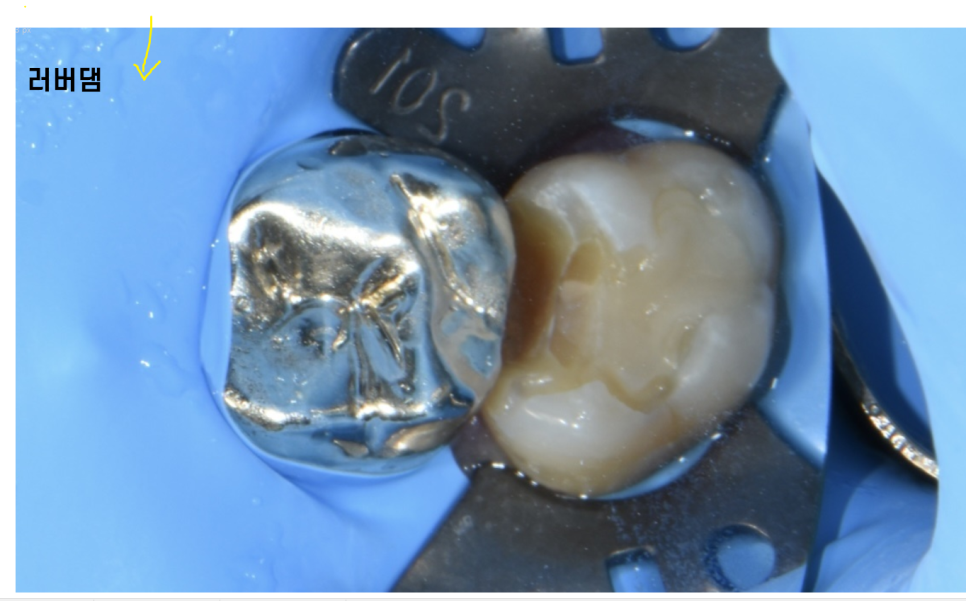 앞니 레진 재치료 변색 부위 연마하면 처음 느낌 그대로 관련 이미지 7
