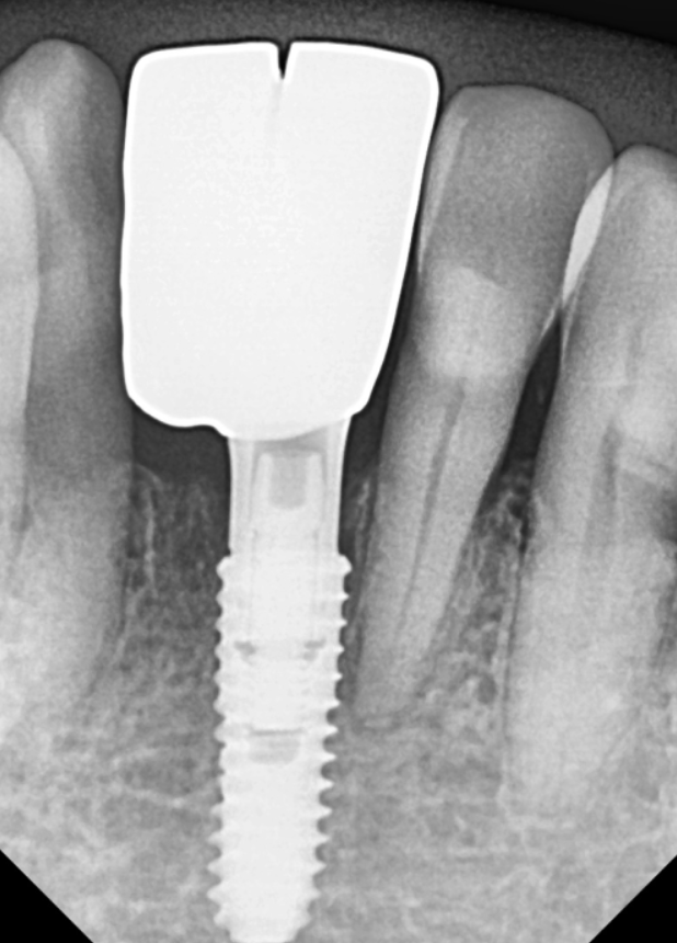 고덕동 아래 앞니 임플란트 비용 줄이는 비법, 공개합니다. 관련 이미지 12