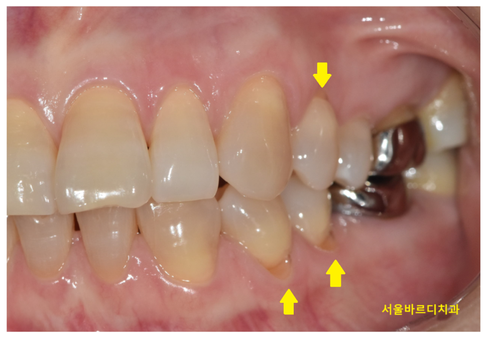 강동구 스케일링 받고 꼭 필요한 한 가지 불소 관련 이미지 1