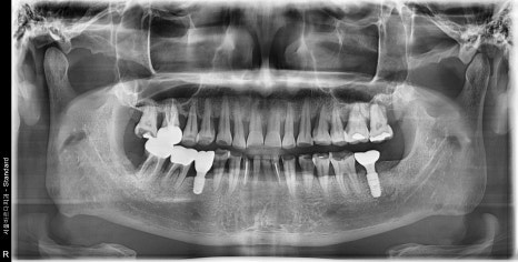 Implant Treatment for a Fractured Molar Split in Half After Neglect Following Root Canal Treatment image 6