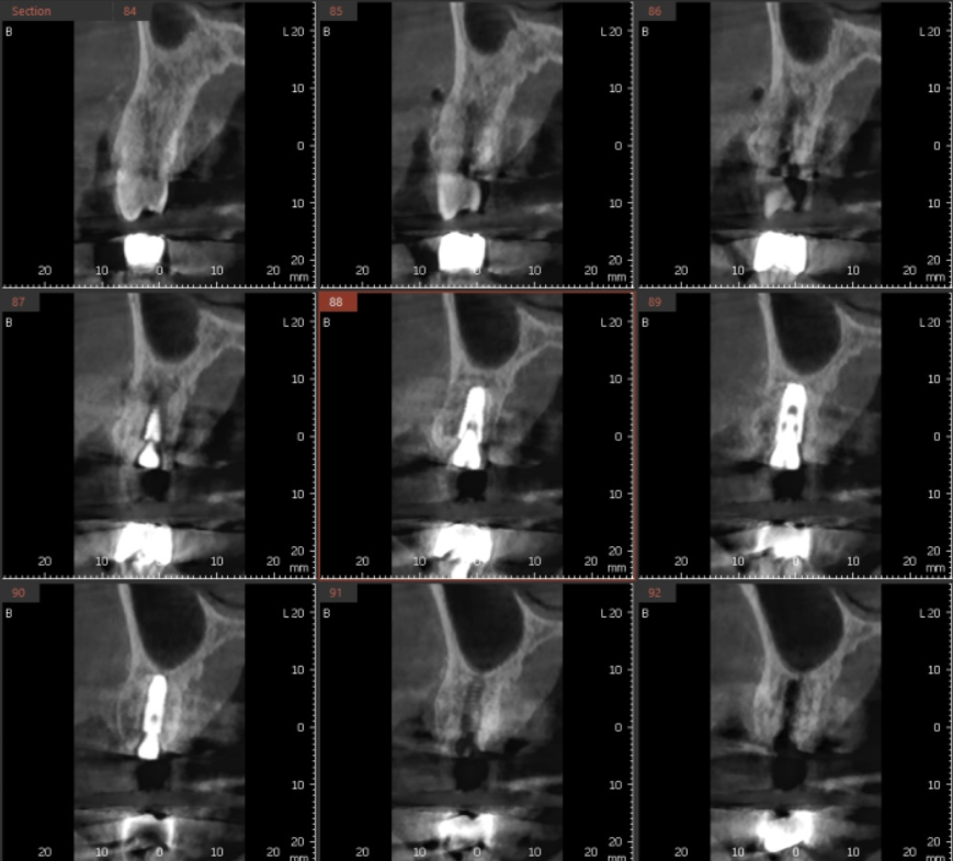 하남 미사 치과 발치 후 당일 임플란트가 가능합니다. 관련 이미지 7