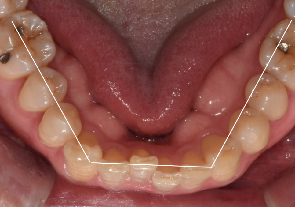 명일역 앞니 부분 교정, 치아 하나만 삐뚤어져 보인다면? 굳이 전체 교정할 필요 없습니다. 관련 이미지 2
