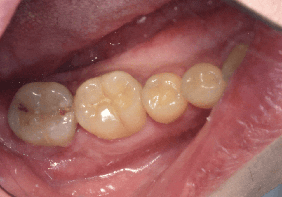 어금니 구멍, 충치 솔직하게 말씀드립니다. 치과 공포증으로 미루신 분들 필독 관련 이미지 4
