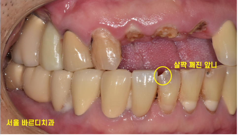 상일동역 치과 부러진 앞니 임플란트로 복구하기 프로젝트 관련 이미지 4